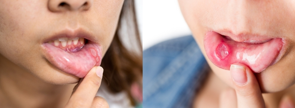Painful Mouth Ulcers